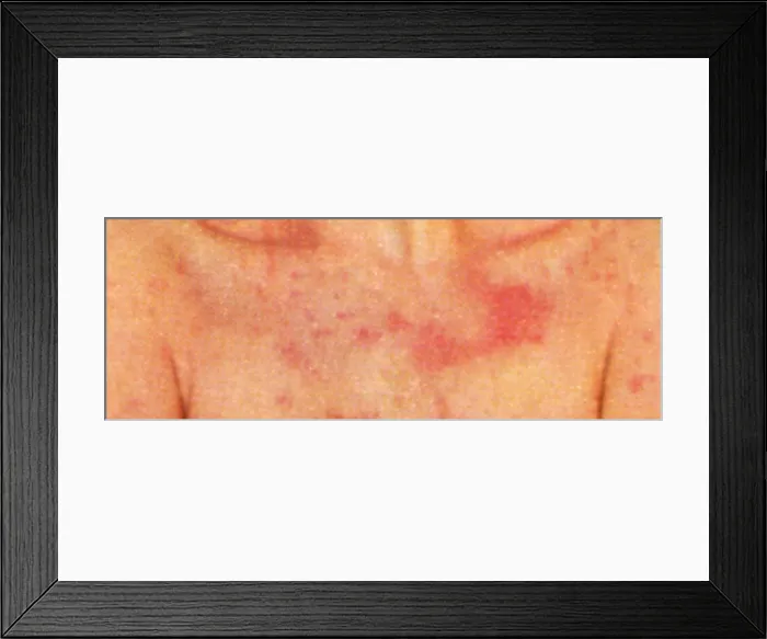 Framed Print : Acute Psoriasis on teh chest of a female patient, autoimmune disease, skin condition Framed Print : Acute Psoriasis on teh chest of a female patient, autoimmune disease, skin condition