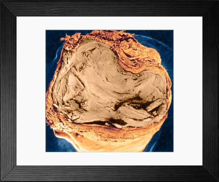 Framed Print : Atherosclerosis SEM, full blockage Framed Print : Atherosclerosis SEM, full blockage