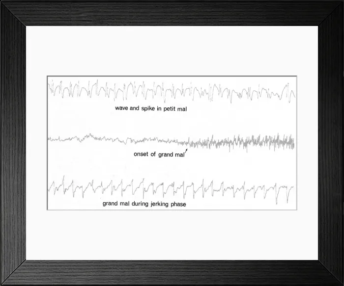 Framed Print : EEG of Epileptic Seizures