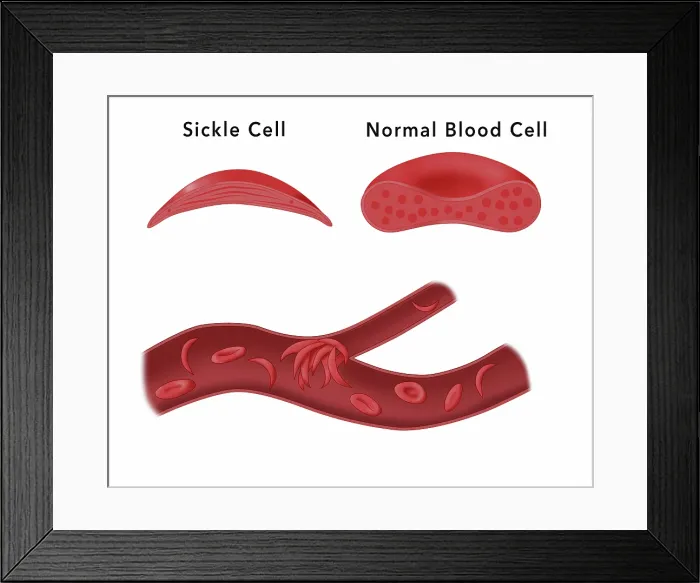 Framed Print : Sickle cell anemia disease, a normal blood cell, a sickle shaped blood cell, a clogged artery or blood vessel, illustration Framed Print : Sickle cell anemia disease, a normal blood cell, a sickle shaped blood cell, a clogged artery or blood vessel, illustration