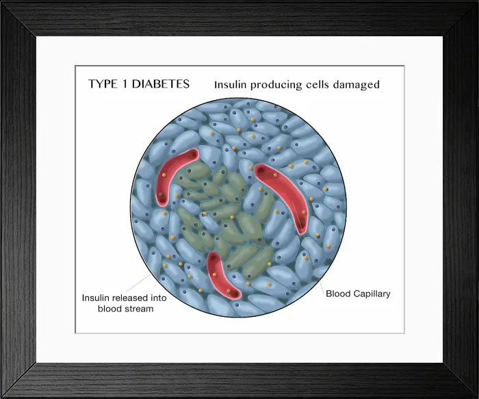Framed Print : Type 1 Diabetes, Damaged Islets of Langerhans Cells Framed Print : Type 1 Diabetes, Damaged Islets of Langerhans Cells