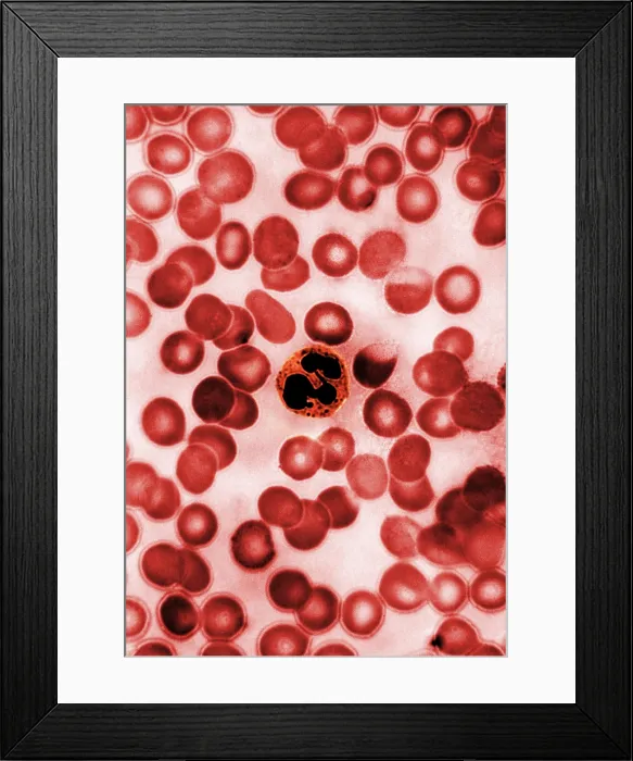 Framed Print : Leukocyte, Drumstick, light micrograph Framed Print : Leukocyte, Drumstick, light micrograph