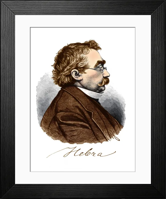 Framed Print : Ferdinand von Hebra, German Dermatologist Framed Print : Ferdinand von Hebra, German Dermatologist