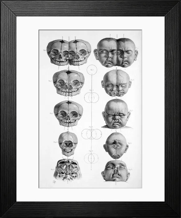 Framed Print : Surgical Anatomy, 1856 Framed Print : Surgical Anatomy, 1856