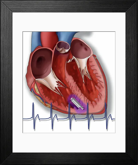 Framed Print : Leadless Pacemaker, Illustration Framed Print : Leadless Pacemaker, Illustration