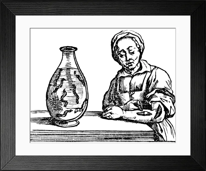 Framed Print : Bloodletting, Leech Method Framed Print : Bloodletting, Leech Method