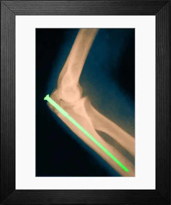 Framed Print : Broken Arm with Metal Pin, X-Ray Framed Print : Broken Arm with Metal Pin, X-Ray