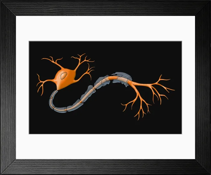 Framed Print : Demyelination Framed Print : Demyelination