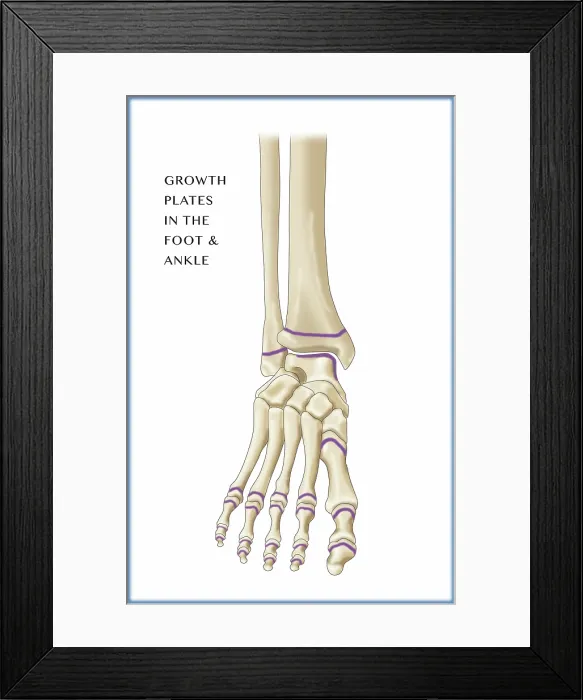 Framed Print : Foot Growth Plates, Illustration Framed Print : Foot Growth Plates, Illustration