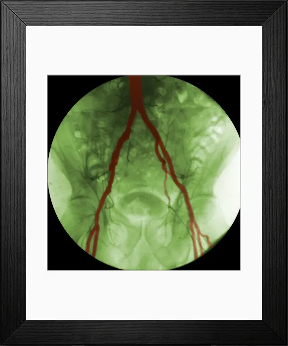 Framed Print : Angiogram of Iliac Arteries