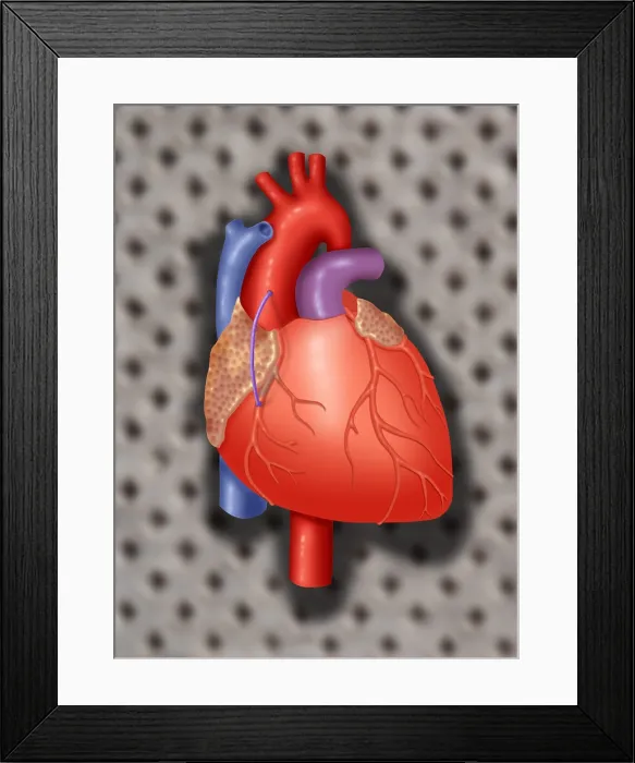 Framed Print : Coronary Vein Graft Framed Print : Coronary Vein Graft