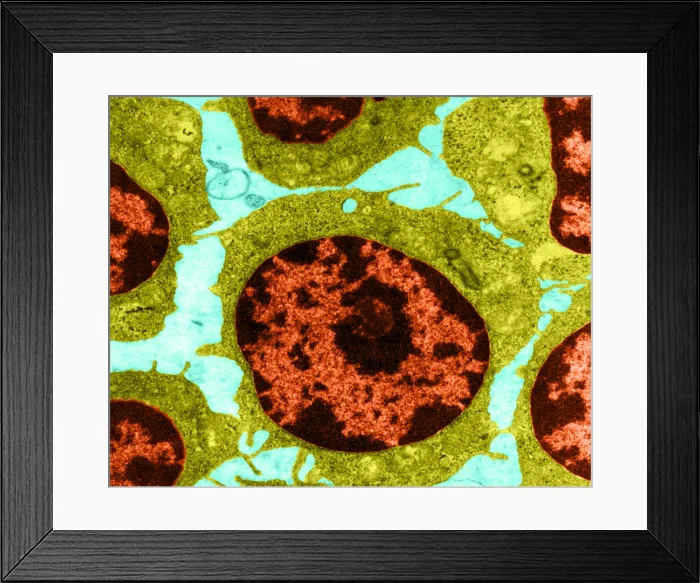 Framed Print : White Blood Cells in Leukemia (TEM) Framed Print : White Blood Cells in Leukemia (TEM)