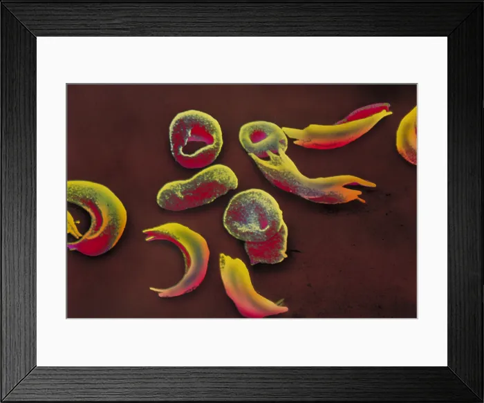 Framed Print : SCD, Sickle-Cell Anemia, under a microscope (SEM) Framed Print : SCD, Sickle-Cell Anemia, under a microscope (SEM)