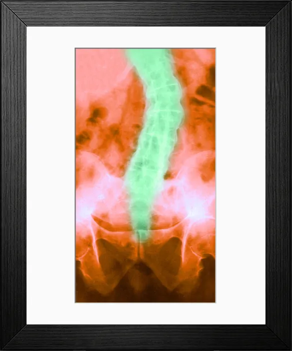 Framed Print : Ankylosing Spondylitis, X-Ray