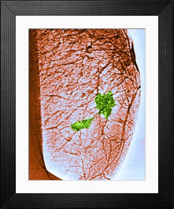 Framed Print : Mammogram. Color enhanced mammogram showing tumors in the breast tissue Framed Print : Mammogram. Color enhanced mammogram showing tumors in the breast tissue