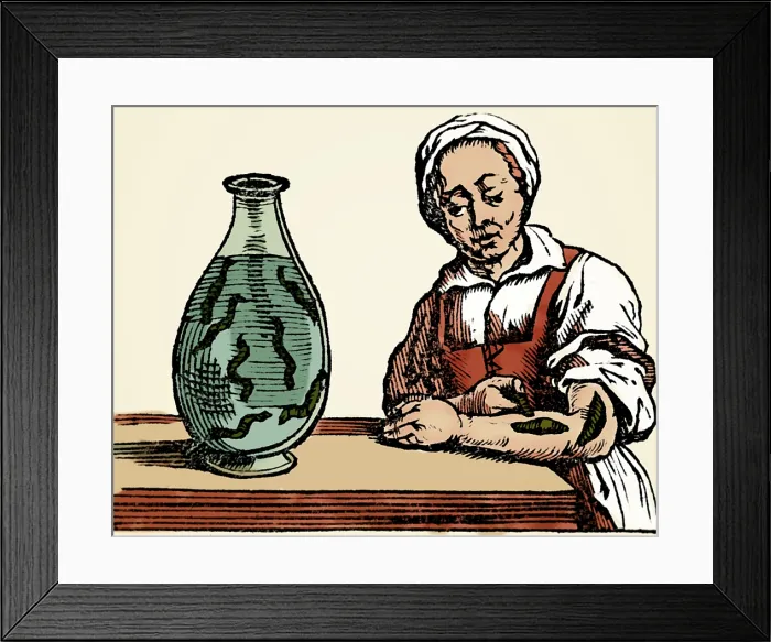 Framed Print : Bloodletting, Leech Method Framed Print : Bloodletting, Leech Method