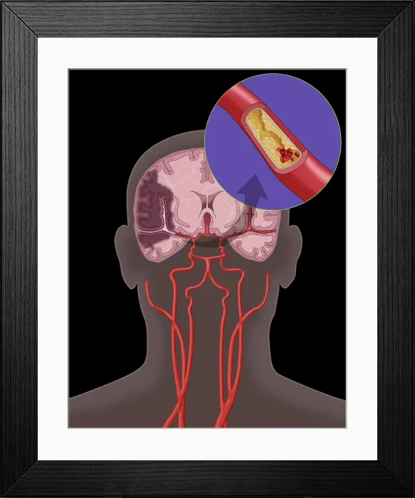 Framed Print : Ischemic Stroke, Illustration Framed Print : Ischemic Stroke, Illustration
