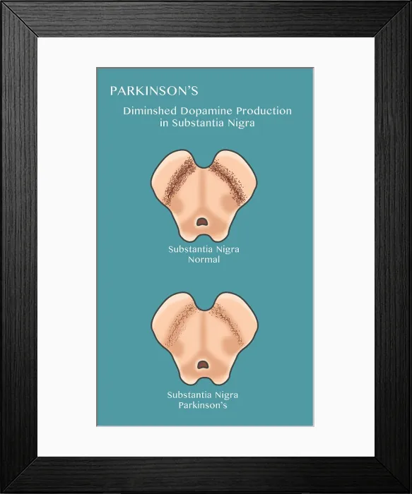 Framed Print : The substantia nigra region of the brain in Parkinson's disease has diminished dopamine transmission in neurons, Illustration Framed Print : The substantia nigra region of the brain in Parkinson's disease has diminished dopamine transmission in neurons, Illustration