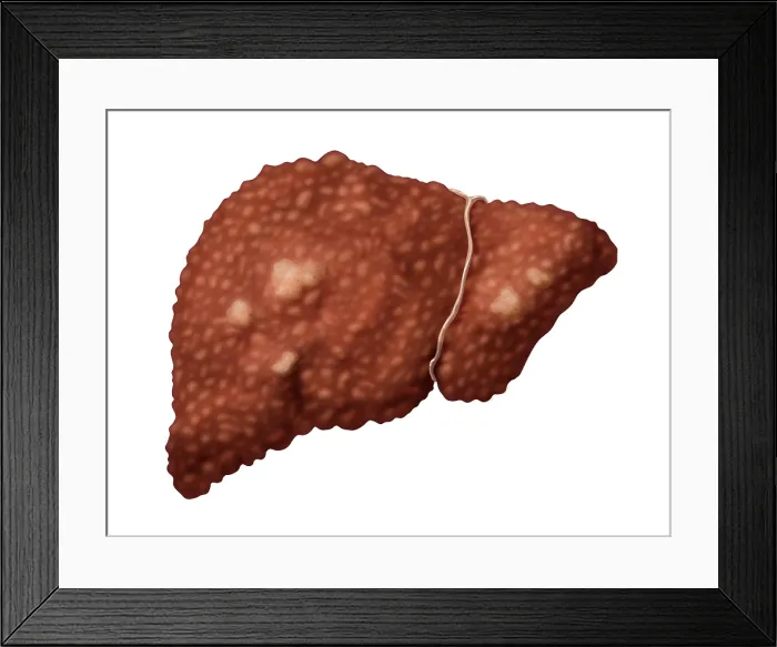 Framed Print : Hepatocellular Carcinoma Framed Print : Hepatocellular Carcinoma