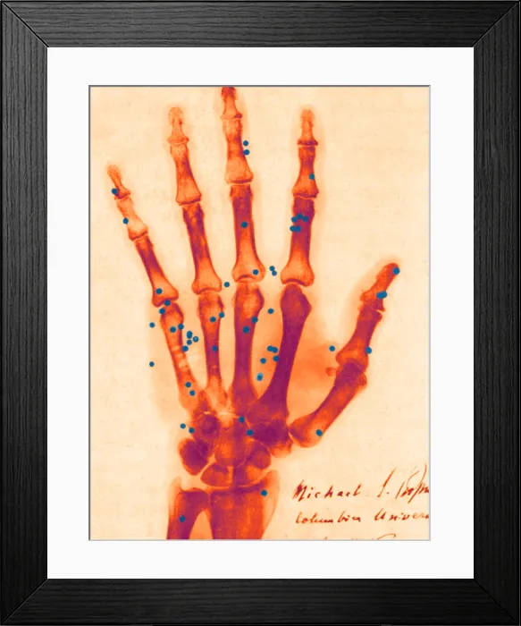 Framed Print : X-ray of Gunshot in the Hand, 1896 Framed Print : X-ray of Gunshot in the Hand, 1896