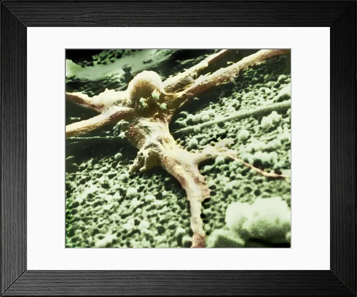 Framed Print : Malignant cancer cell Framed Print : Malignant cancer cell