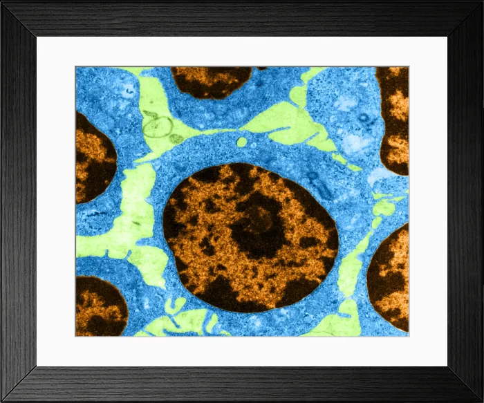 Framed Print : White Blood Cells in Leukemia (TEM) Framed Print : White Blood Cells in Leukemia (TEM)
