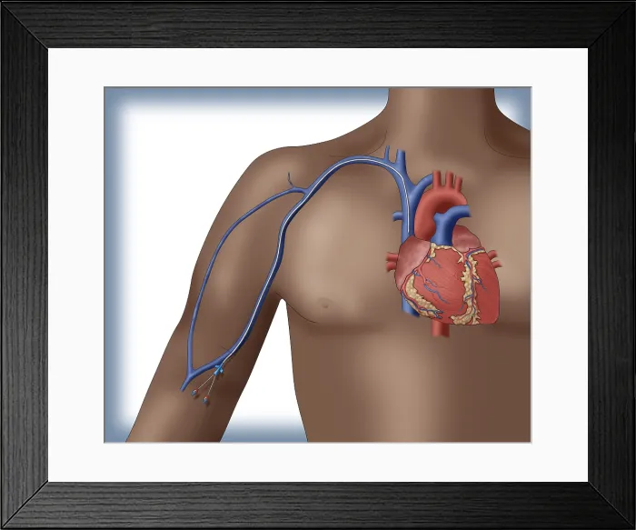 Framed Print : PICC intravenous device, Illustration Framed Print : PICC intravenous device, Illustration