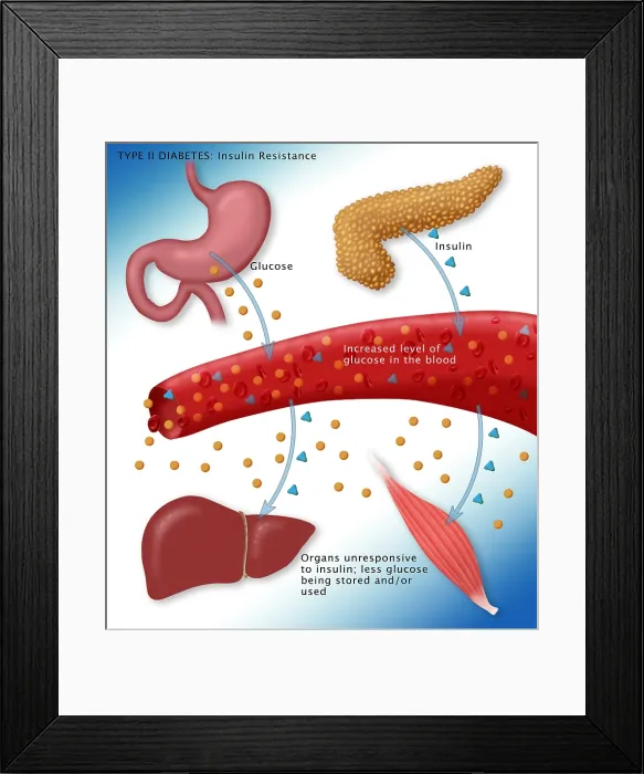 Framed Print : Type II diabetes microbiology diagram of insulin, glucose, blood vessels, pancreas, stomach, medical illustration
