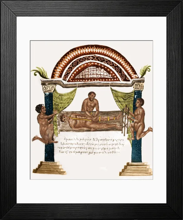 Framed Print : Joint Dislocation Treatment, 1st Century BC Framed Print : Joint Dislocation Treatment, 1st Century BC