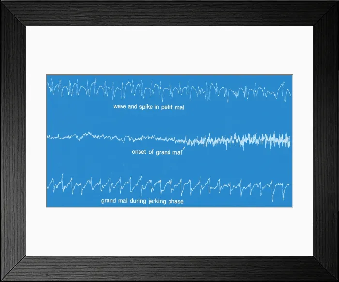 Framed Print : EEG of Epileptic Seizures
