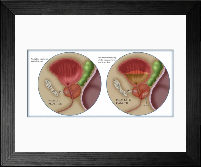 Framed Print : Prostate Cancer, Illustration