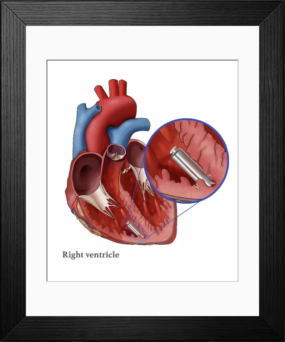 Framed Print : Leadless Pacemaker, Illustration Framed Print : Leadless Pacemaker, Illustration