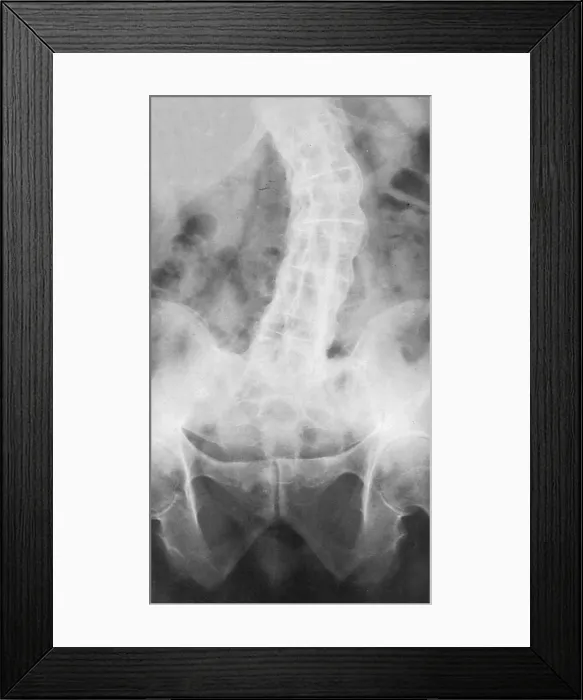 Framed Print : Ankylosing Spondylitis, X-Ray Framed Print : Ankylosing Spondylitis, X-Ray