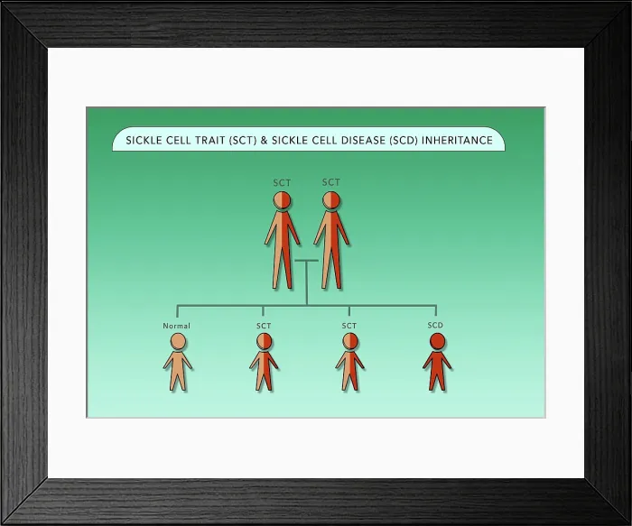Framed Print : Sickle Cell Trait (SCT) and Sickle Cell Anemia Disease (SCD) genetic inheritance chart, medical illustration Framed Print : Sickle Cell Trait (SCT) and Sickle Cell Anemia Disease (SCD) genetic inheritance chart, medical illustration