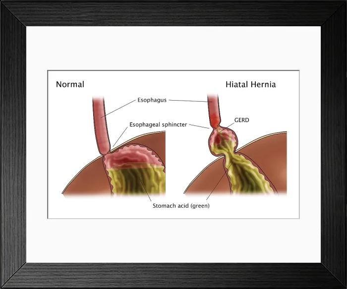 Framed Print : GERD and Hiatal Hernia, Illustration