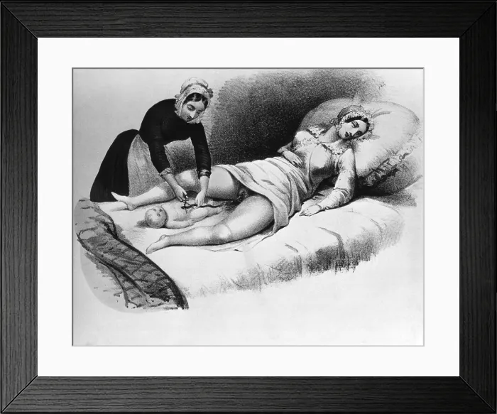 Framed Print : Midwife Cutting Umbilical Cord, 1850 Framed Print : Midwife Cutting Umbilical Cord, 1850