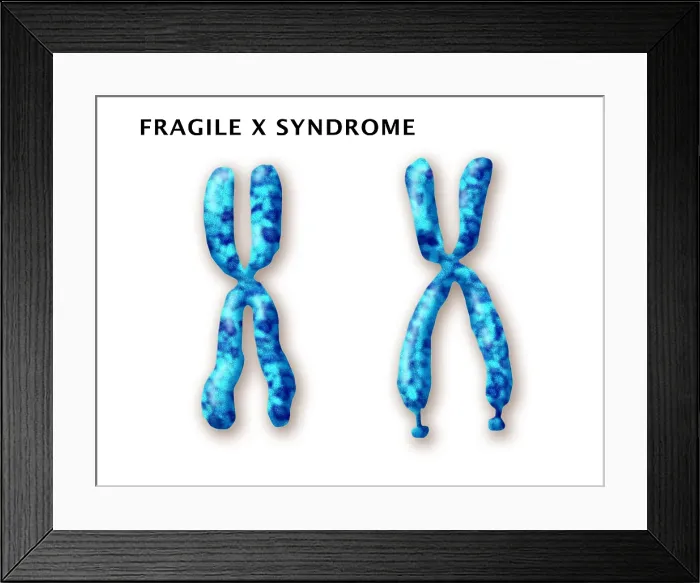 Framed Print : Fragile X Syndrome (FXS) is a genetic condition often associated with autism spectrum disorder (ASD), illustration