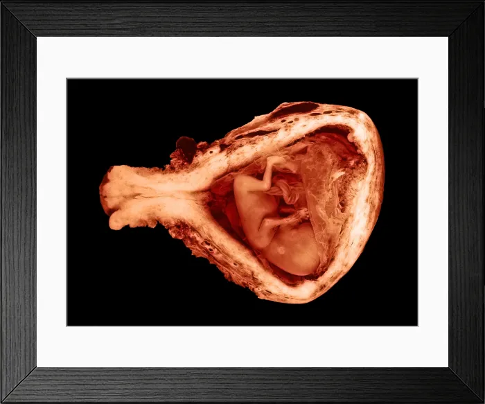 Framed Print : 13 week old human fetus Framed Print : 13 week old human fetus