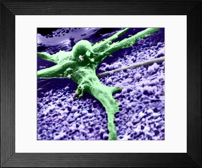 Framed Print : Malignant cancer cell Framed Print : Malignant cancer cell