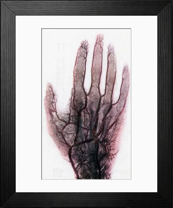 Framed Print : X-ray of Blood Vessels