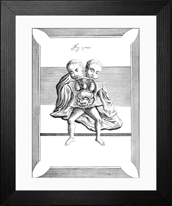 Framed Print : Conjoined Twins, 18th Century Framed Print : Conjoined Twins, 18th Century