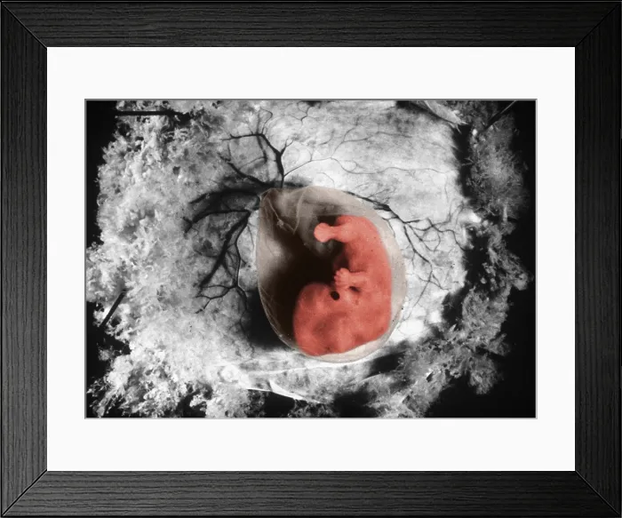 Framed Print : Human Embryo, gross specimen Framed Print : Human Embryo, gross specimen