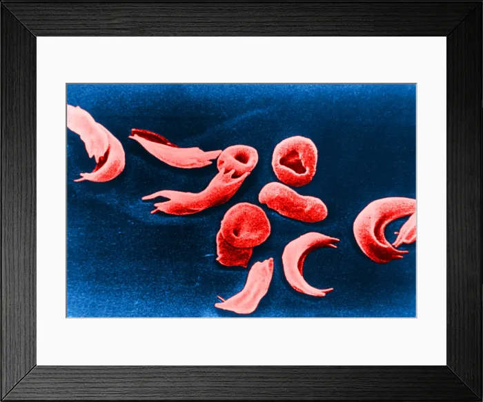 Framed Print : SCD, Sickle-Cell Anemia, under a microscope (SEM) Framed Print : SCD, Sickle-Cell Anemia, under a microscope (SEM)