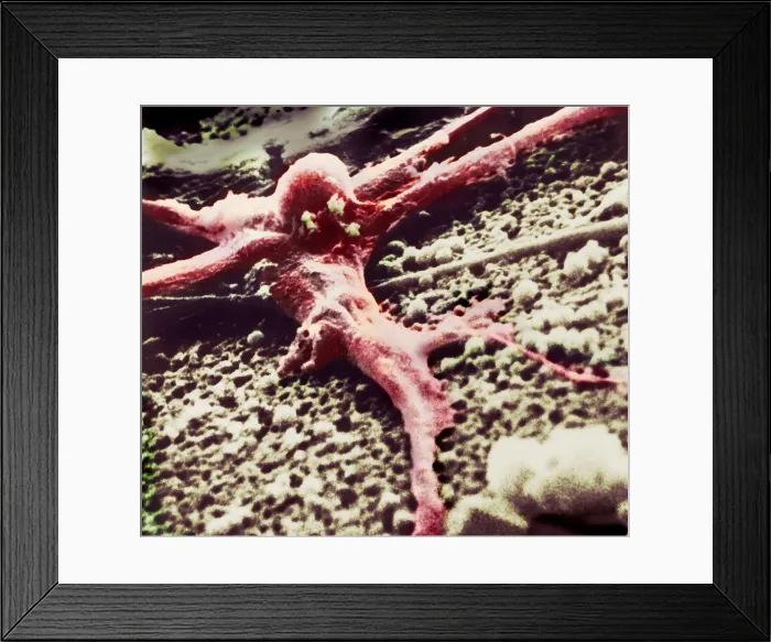 Framed Print : Malignant cancer cell Framed Print : Malignant cancer cell