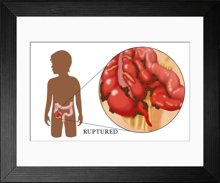 Framed Print : Ruptured Appendix Framed Print : Ruptured Appendix