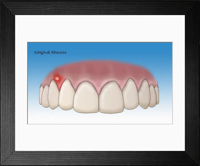 Framed Print : Gingival Abscess, Illustration Framed Print : Gingival Abscess, Illustration
