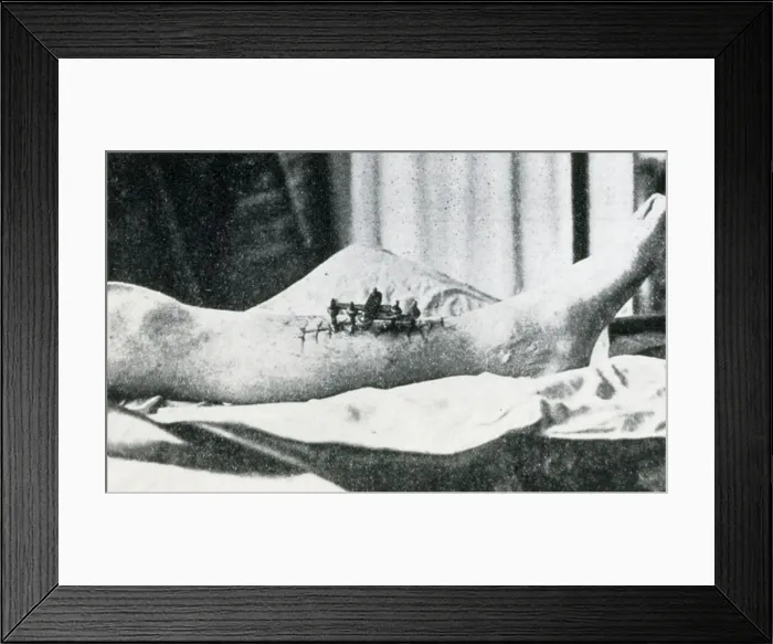 Framed Print : Bone Clamp Framed Print : Bone Clamp