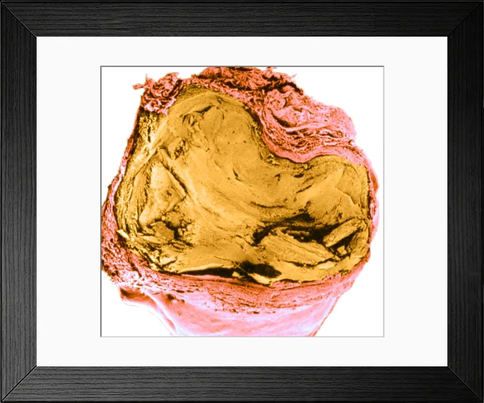 Framed Print : Atherosclerosis SEM, full blockage Framed Print : Atherosclerosis SEM, full blockage