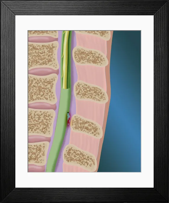 Framed Print : CSF Leak in the Spinal Cord Framed Print : CSF Leak in the Spinal Cord