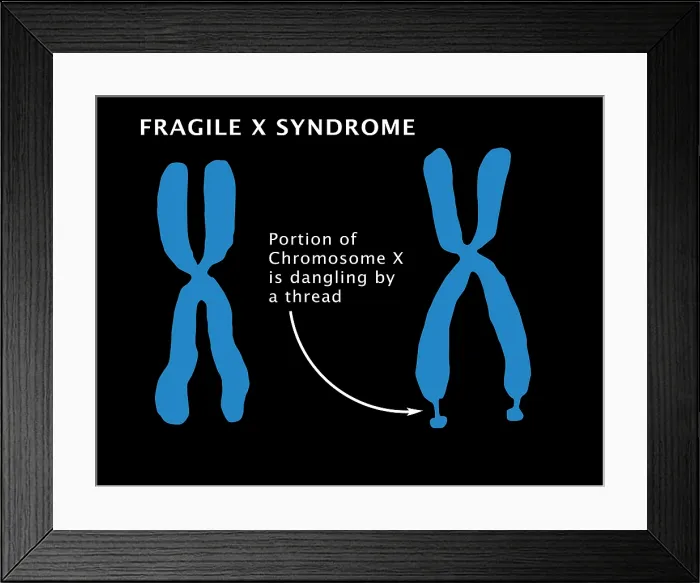Framed Print : Fragile X Syndrome (FXS) is a genetic condition often associated with autism spectrum disorder (ASD), illustration Framed Print : Fragile X Syndrome (FXS) is a genetic condition often associated with autism spectrum disorder (ASD), illustration